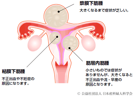 外陰 癌 しこり 画像