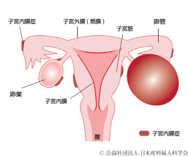 嚢胞 バルトリン しこり 腺